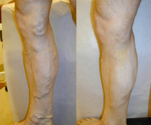 Leg_3_-_2_weeks